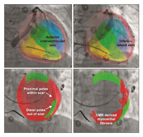 lv lead placement in therapy